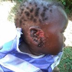 This baby with a severely infected ear visited our clinic.